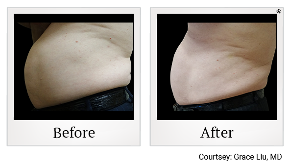 Before and After Photo 14 of Vanquish ME™ treatment at SF Bay Cosmetic Surgery Medical Group in San Ramon