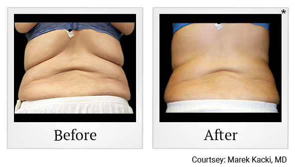 Before and After Photo 18 of Vanquish ME™ treatment at SF Bay Cosmetic Surgery Medical Group in San Ramon