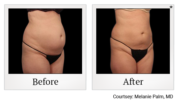 Before and After Photo 5 of Vanquish ME™ treatment at SF Bay Cosmetic Surgery Medical Group in San Ramon