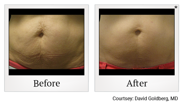 Before and After Photo 7 of Vanquish ME™ treatment at SF Bay Cosmetic Surgery Medical Group in San Ramon