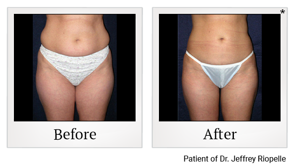 Before and After Photo 1 of Vaser® Shape treatment at SF Bay Cosmetic Surgery Medical Group in San Ramon