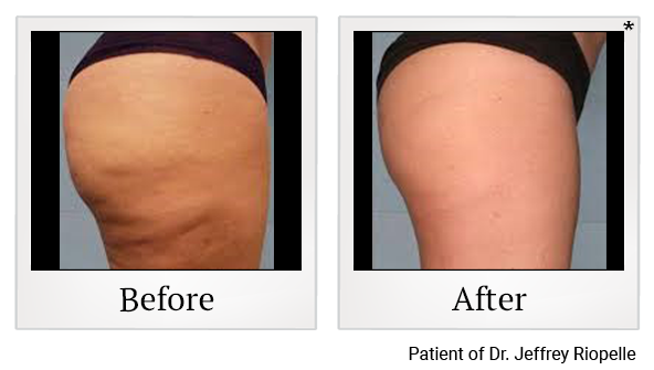 Before and After Photo 2 of Vaser® Smooth treatment at SF Bay Cosmetic Surgery Medical Group in San Ramon