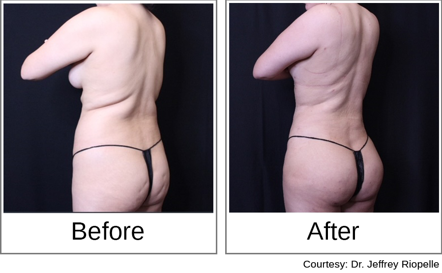 Brazilian Butt Lift Before and After 2