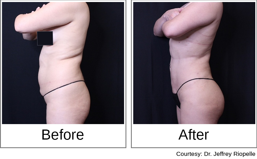 Brazilian Butt Lift Before and After 4