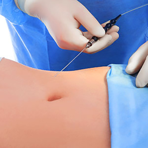 Treat turkey neck with our Smartlipo® & Lipo at SF Bay Cosmetic Surgery Medical Group in San Ramon