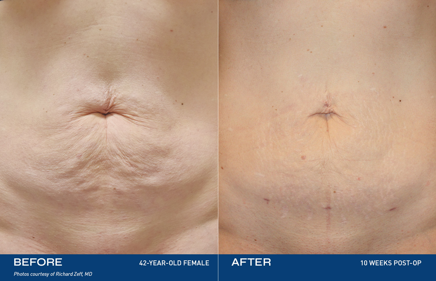 Renuvion Treatment Areas