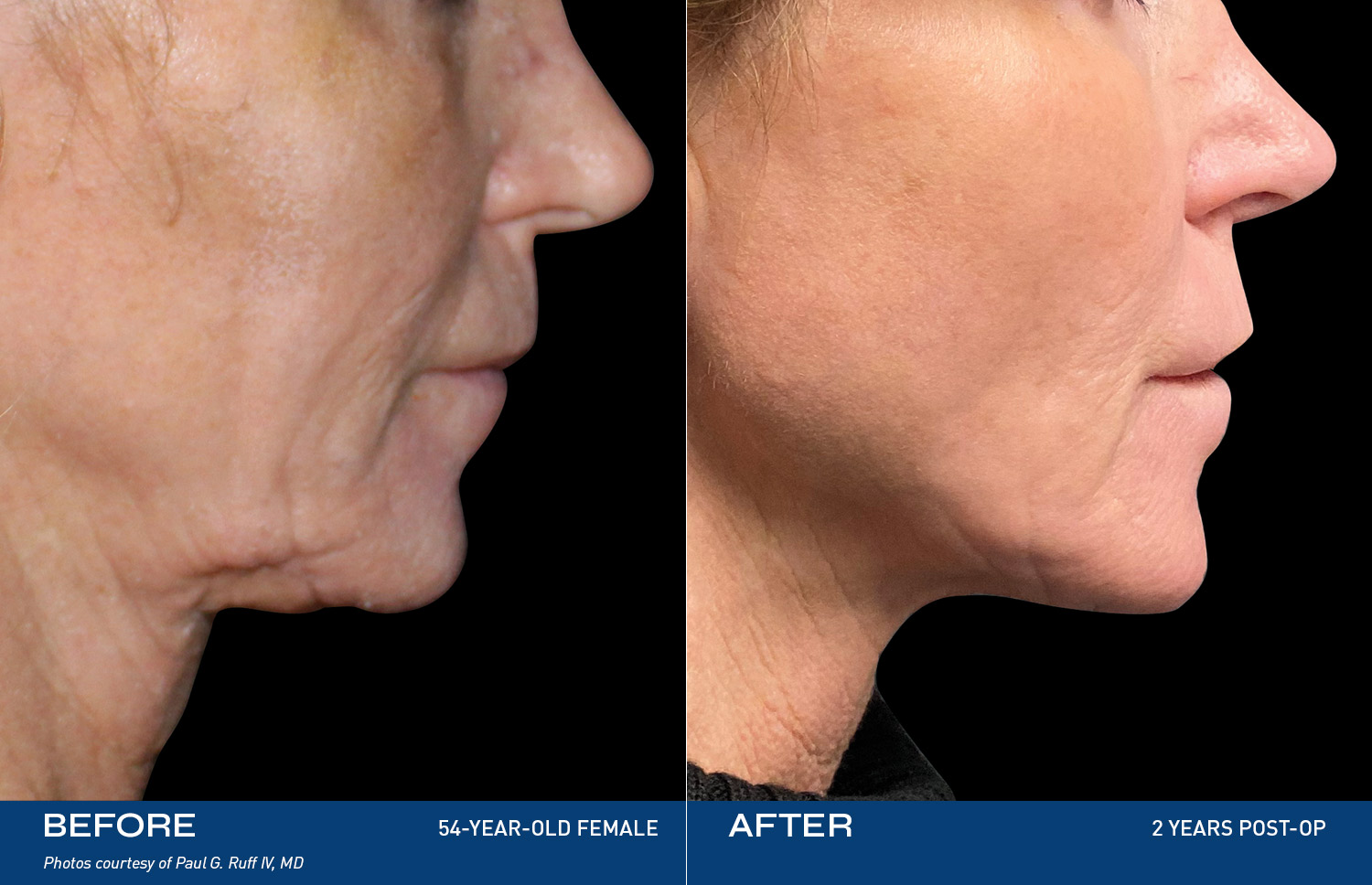 Renuvion Treatment Areas