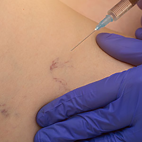 Image of patient being treated with Sclerotherapy