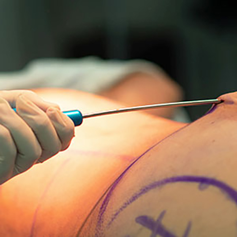 Image of patient being treated with Vaser Smooth