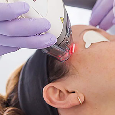 Treat Fine Lines with our Fraxel® at SF Bay Cosmetic Surgery Medical Group in San Ramon