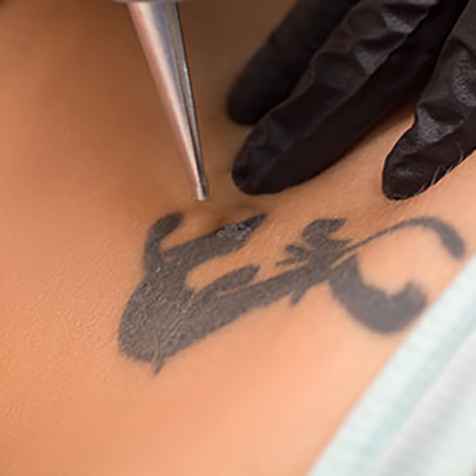 Image of patient being treated with Laser Tattoo Removal