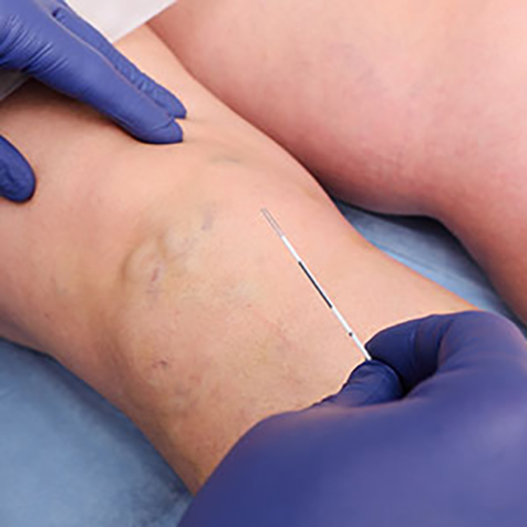 Image of patient being treated with Laser Vein Therapy