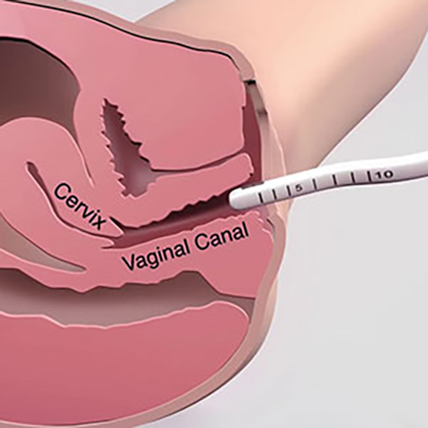 Image of patient being treated with Vaginal Rejuvenation